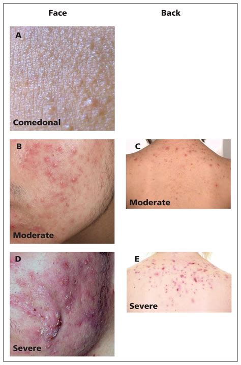 Acne Treatment Guidelines