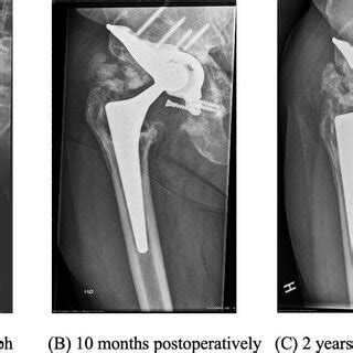 A Preoperative Radiograph Of A Year Old Male Anteroposterior View