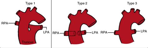 Truncus Arteriosus Clinical Gate