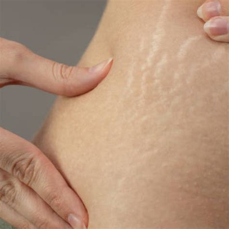 Ini Dia Cara Menghilangkan Stretch Mark Secara Alami