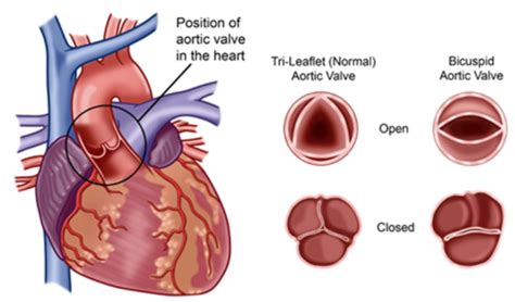 Valvular Disorders Part I Flashcards Quizlet