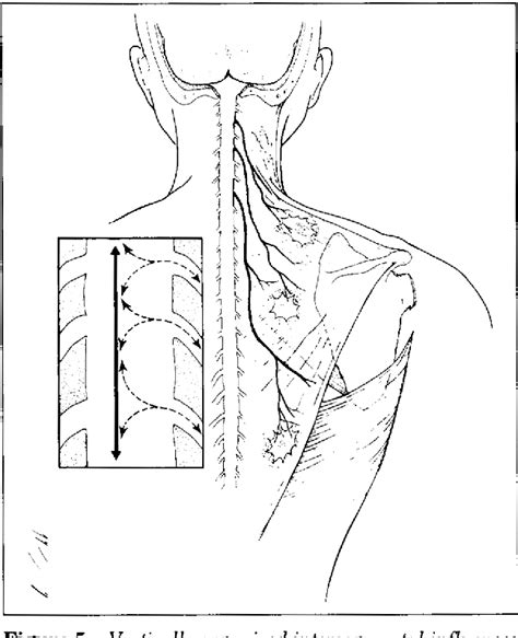 Pdf Thoracic Outlet Syndrome A Myofascial Variant Part 3 Structural And Postural