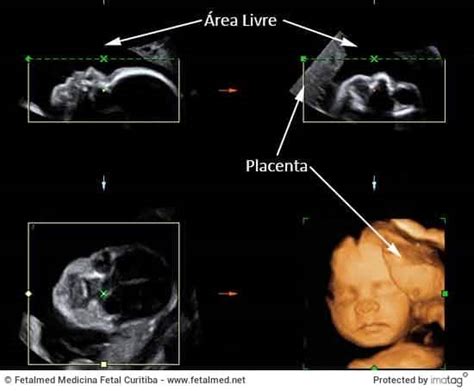 O Que Ultrassom D Ou D Fetalmed Medicina Fetal