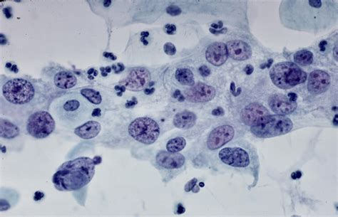 Mycytopathology On Twitter A Beautiful Example Of Typical Repair In