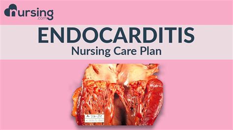 What Is Endocarditis And How To Write A Care Plan For It As A Nurse