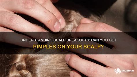 Understanding Scalp Breakouts Can You Get Pimples On Your Scalp