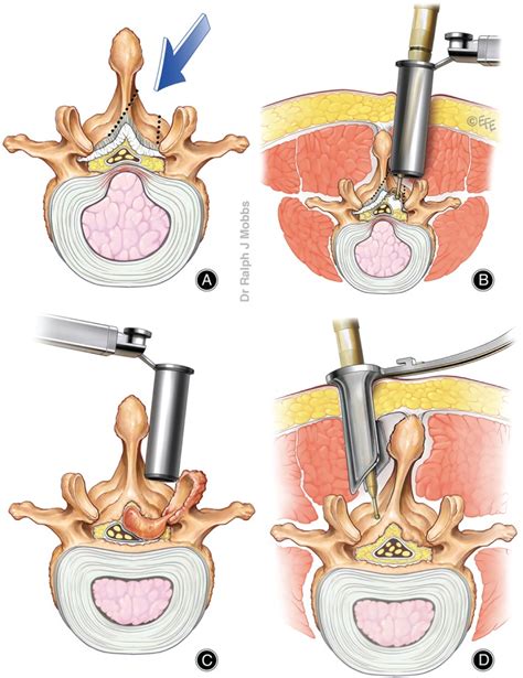 Treatment Of Lumbar Spinal Stenosis By Microscopic Unilateral