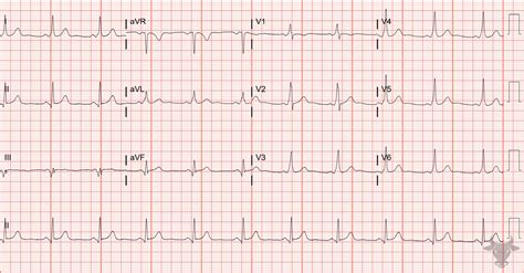 Ventricular Pre-excitation | ECG Stampede