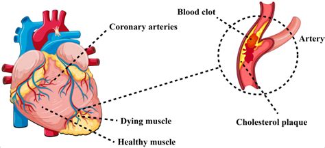 Illustration Of Myocardial Infarct Caused By Acute Thrombus In The