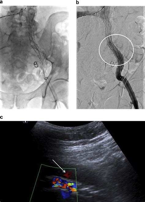 Ultrasound Assisted On Table Management Of Type III Endoleak At