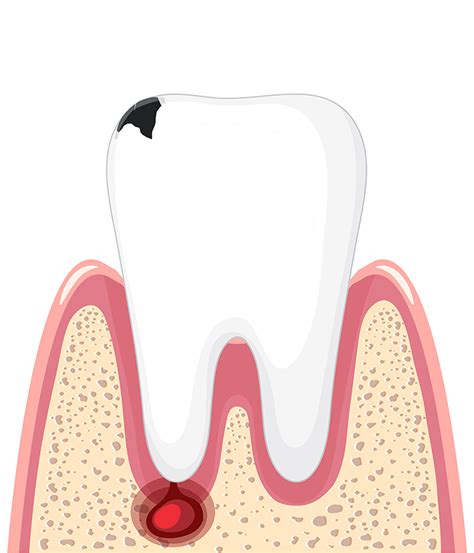 Il Granuloma Dentale Meeting Works