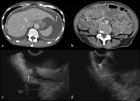 Gastrointestinal Successful Diagnosis Of Primary Peritoneal Serous