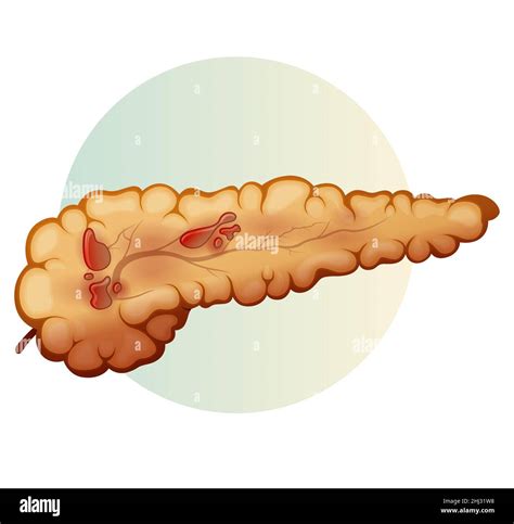 Pancreas Acute Pancreatitis Stock Illustration As Eps 10 File Stock