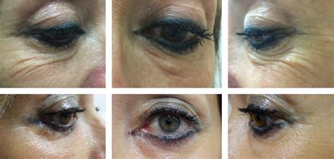 Blefaroplastia fotos Recomendaciones y Guía 2019