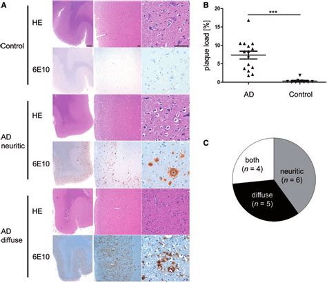 Histology Plaque Load And Classification Of Patient Cohorts Frontal