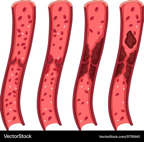 Blood Clot Diagram