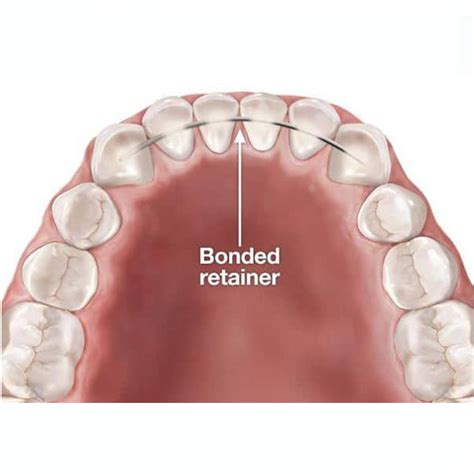 Retainer - Fixed Bonded Wire - Forever Aligned Club