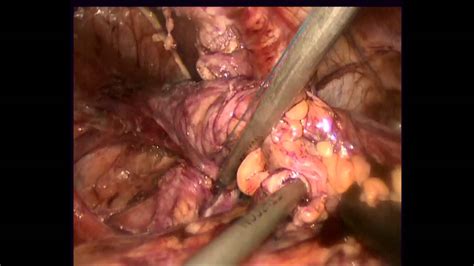 Robotic Laparoscopic Transhiatal Anatomic Repair Of Hiatal Hernias