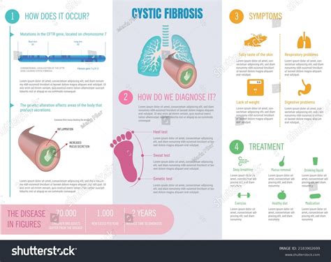 Infographic About Cystic Fibrosis Disease What Royalty Free Stock