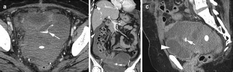 Peritoneal And Retroperitoneal Diseases Radiology Key