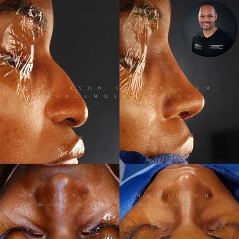 African American Rhinoplasty Specialist In Los Angeles Ca