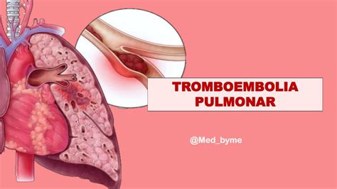 Tromboembolia Pulmonar Med Byme Udocz