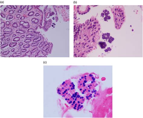 Sarcina Infection Bmj Case Reports