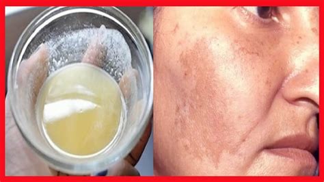 MELASMA Receita Caseira Que ACABA As MANCHAS DE MELASMA Sem Gastar