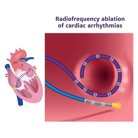 259 Ablation Catheter Images Stock Photos 3D Objects Vectors