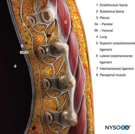 Regional Anesthesia Sagittal Section Through The Thoracic Paravertebral