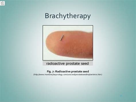 Brachytherapy: Prostate Cancer