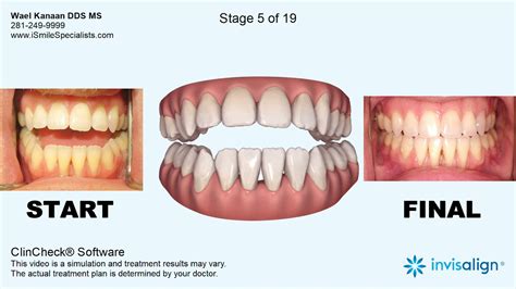 Can Invisalign Fix Canine Teeth