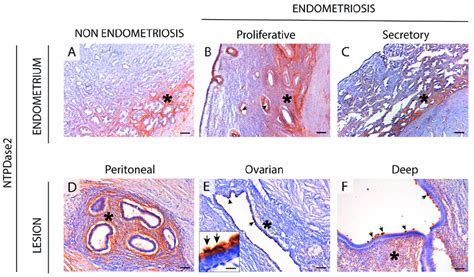 Immunolocalization Of Ntpdase2 In The Eutopic A C And Ectopic D F Download Scientific