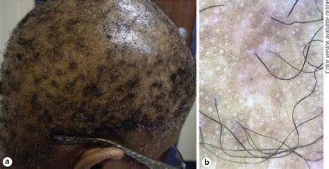 Central Centrifugal Cicatricial Alopecia