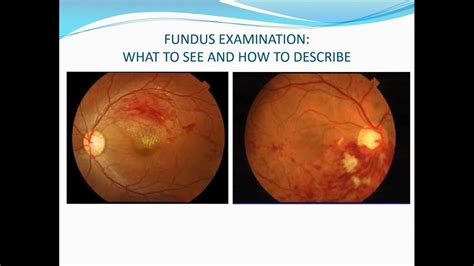 Fundus Examination Volk Lens Direct Ophthalmoscopy And Binocular