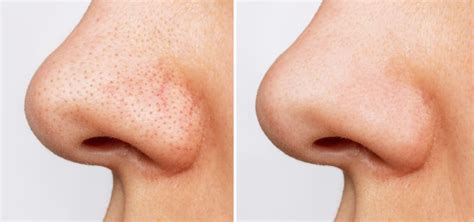 Large Pores Before And After