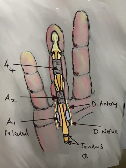 A1 Pulley Release James Henderson Specialist Plastic And Hand Surgeon