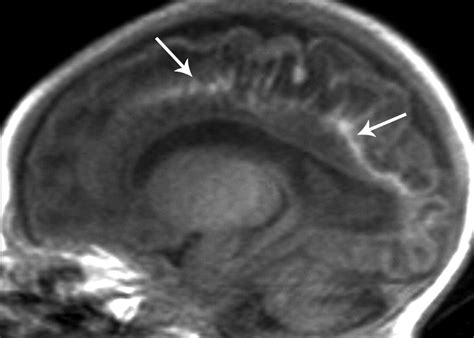 Neonatal Hypoxic Ischemic Encephalopathy Multimodality Imaging