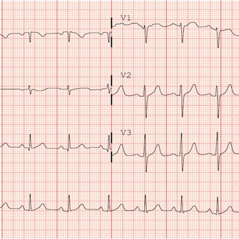 Twelve Lead Electrocardiogram In The Emergency Room Sinus Rhythm With