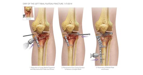 Tibial Plateau Fracture Surgery Renew Physical Therapy