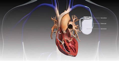 Active Implantable Medical Devices Market Growing at a CAGR of 7.9% by ...