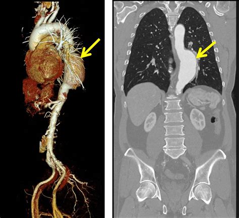 Thoracic Aortic Aneurysm Radiology Cases