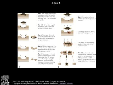 Understanding Mohs Micrographic Surgery Ppt Download