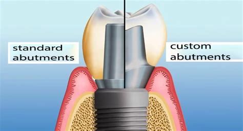 Abutment