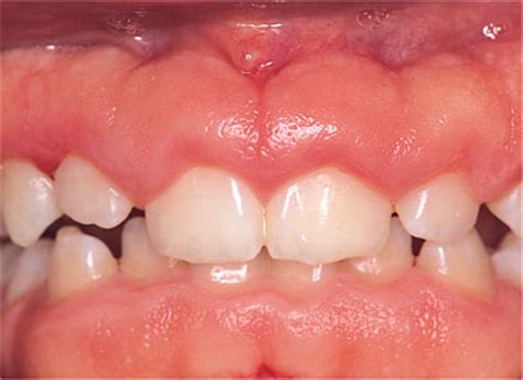 6: Gingival Enlargements – Generalised | Pocket Dentistry