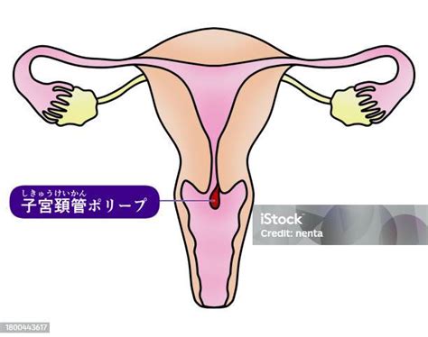 Simple Illustration Of Cervical Polyp Stock Illustration - Download ...