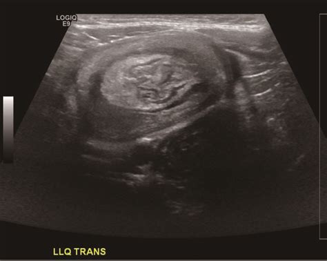 Pediatric Colocolic Intussusception With Pathologic Lead Point A Case