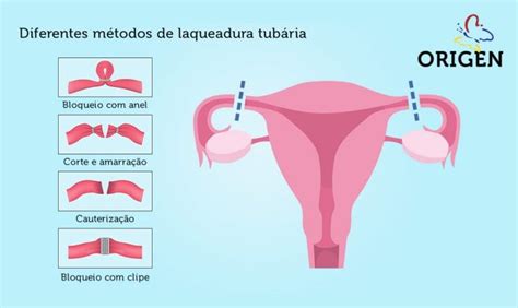 Como É Feito A Laqueadura Fotos