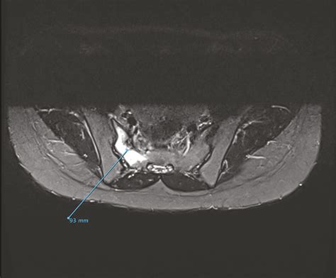 Fracture De Fatigue La Revue Du Praticien