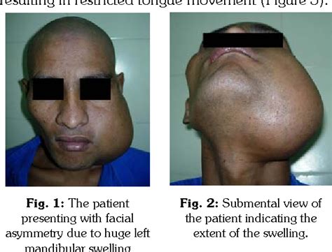 Figure From Management Of Large Mandibular Ameloblastoma A Case